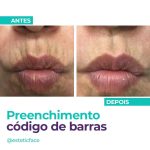 Rugas periorais: saiba como tratar o código de barras