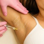 Suor excessivo: é possível resolver o problema com botox?