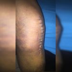Justiça manda PMDF reintegrar sargento que quebrou joelhos em serviço